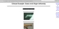 Transformation- Swan neck finger deformity