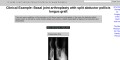 Arthritis- Basal joint arthroplasty with split abductor pollicis longus graft