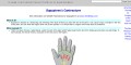 Dupuytrens Contracture EatonHand